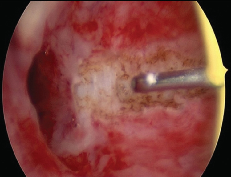 Hysteroscopy showing grade II adhesions in female genital tuberculosis being resected.